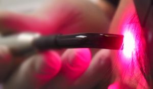 biostimulation tip